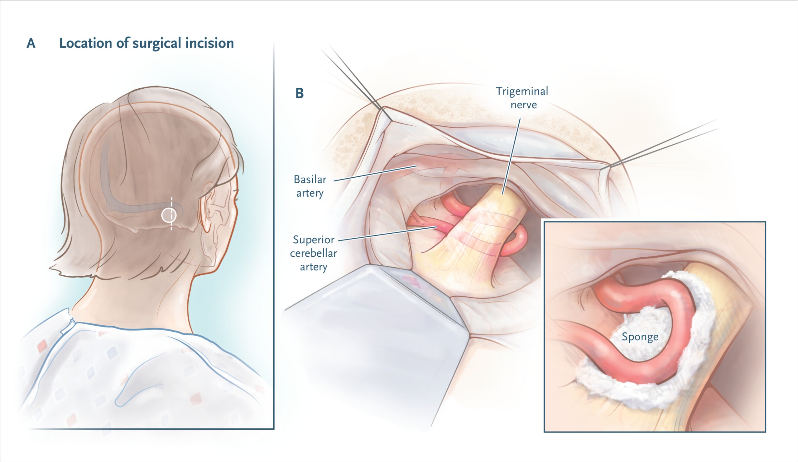 Microcirugía Neuralgia