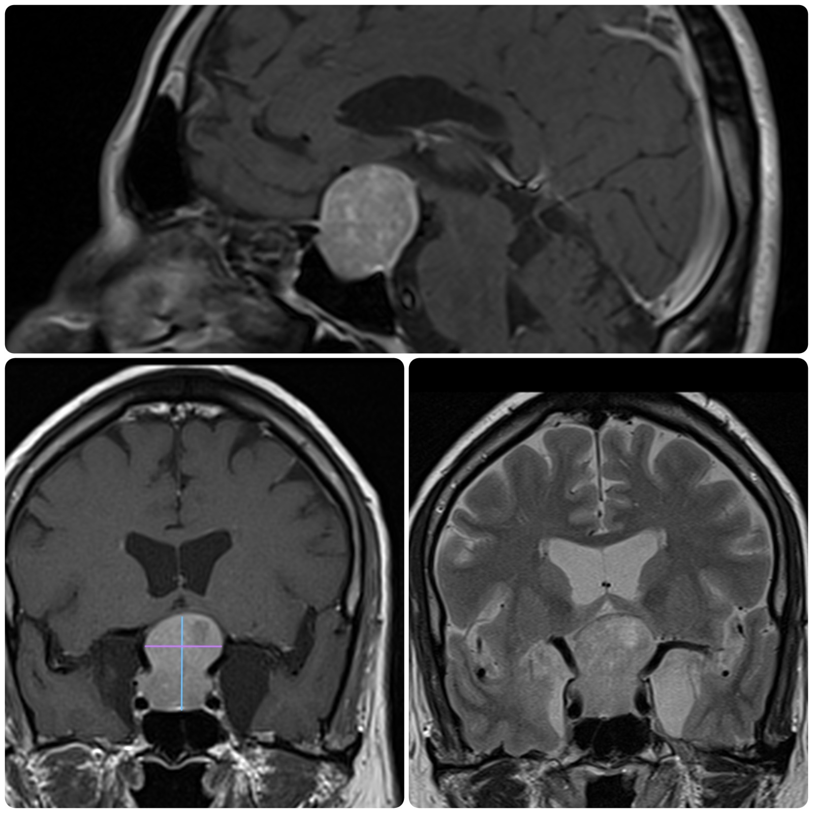 Tipo de Adenoma 1