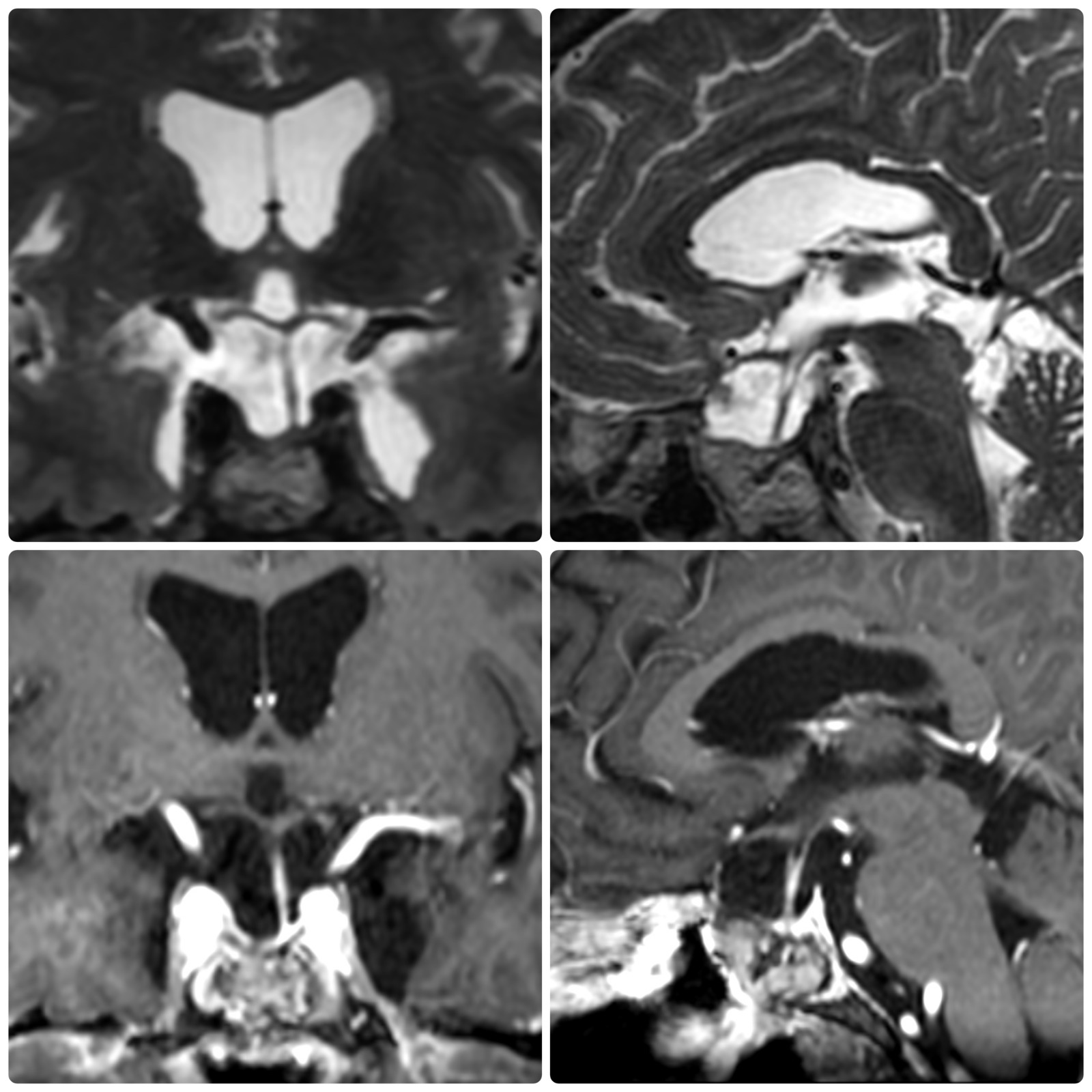 Tipo de Adenoma 2